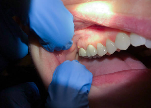 Best Emergency Dental Care for Abscessed Tooth in Somers, MT